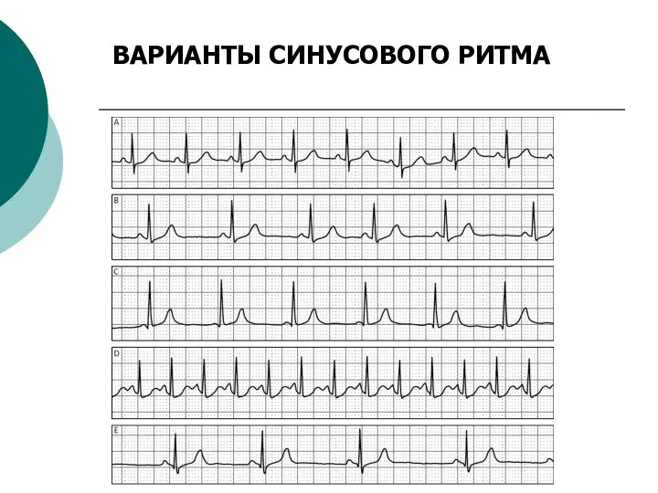 ВАРИАНТЫ СИНУСОВОГО РИТМА