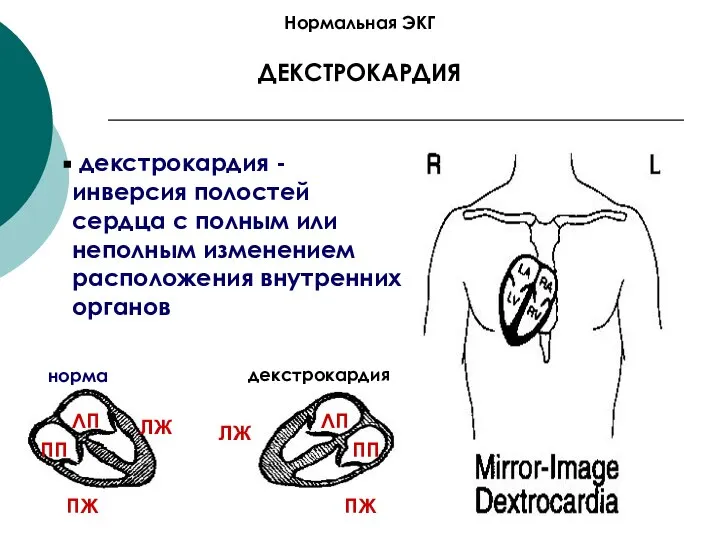 Нормальная ЭКГ ДЕКСТРОКАРДИЯ декстрокардия - инверсия полостей сердца с полным или неполным