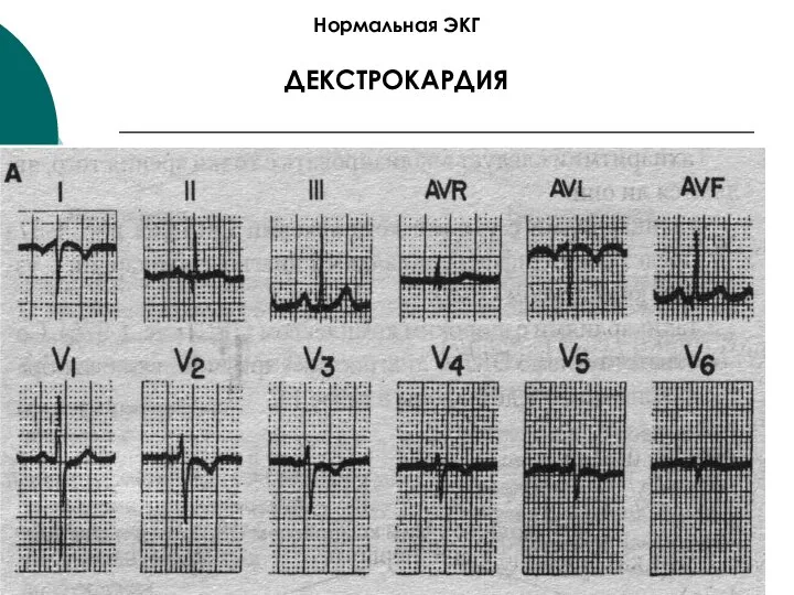 Нормальная ЭКГ ДЕКСТРОКАРДИЯ