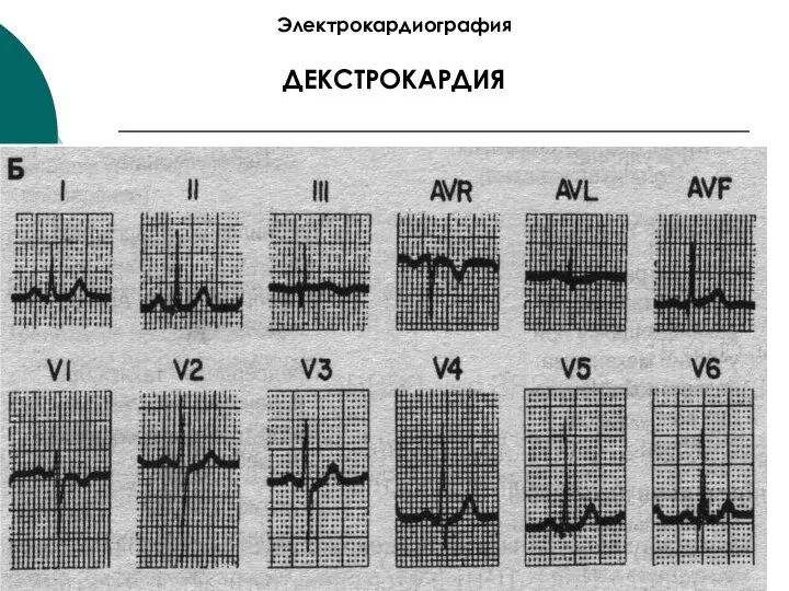 Электрокардиография ДЕКСТРОКАРДИЯ