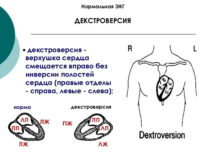 Нормальная ЭКГ ДЕКСТРОВЕРСИЯ декстроверсия - верхушка сердца смещается вправо без инверсии полостей