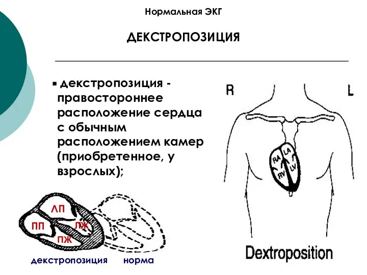 Нормальная ЭКГ ДЕКСТРОПОЗИЦИЯ декстропозиция - правостороннее расположение сердца с обычным расположением камер