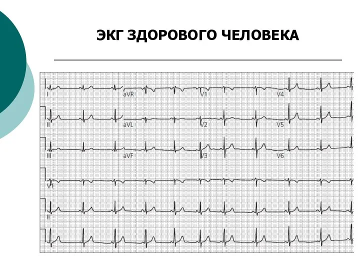 ЭКГ ЗДОРОВОГО ЧЕЛОВЕКА