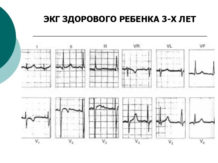 ЭКГ ЗДОРОВОГО РЕБЕНКА 3-Х ЛЕТ