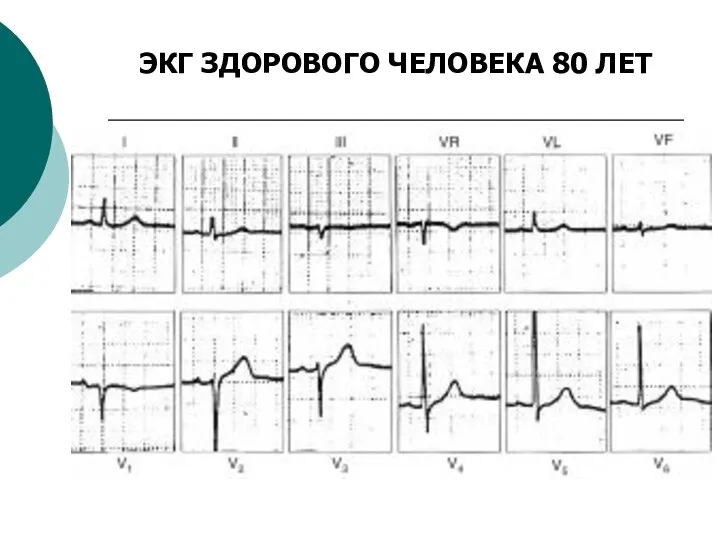 ЭКГ ЗДОРОВОГО ЧЕЛОВЕКА 80 ЛЕТ