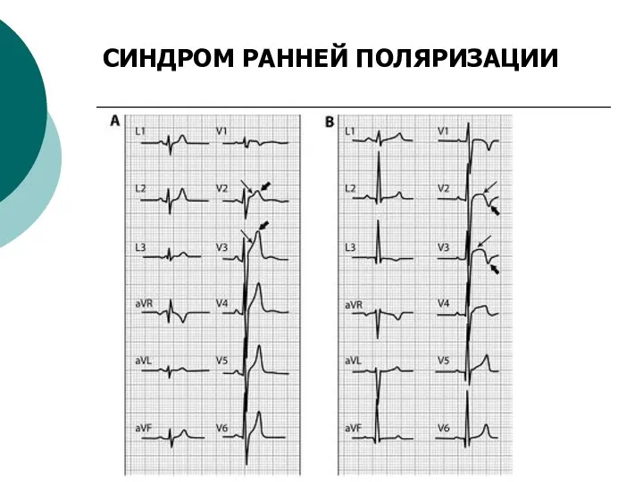 СИНДРОМ РАННЕЙ ПОЛЯРИЗАЦИИ