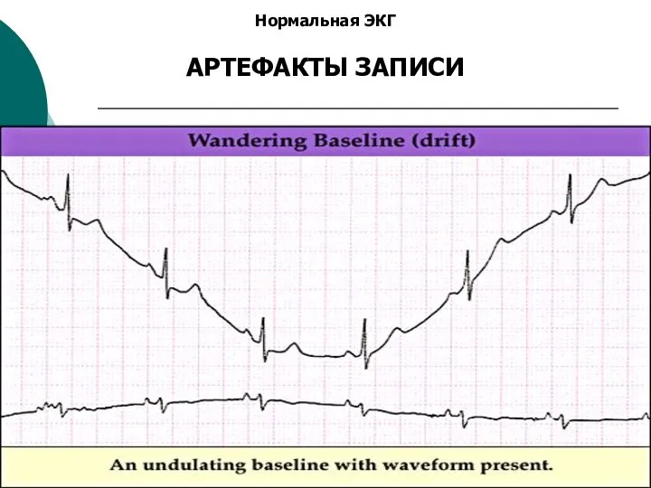 Нормальная ЭКГ АРТЕФАКТЫ ЗАПИСИ