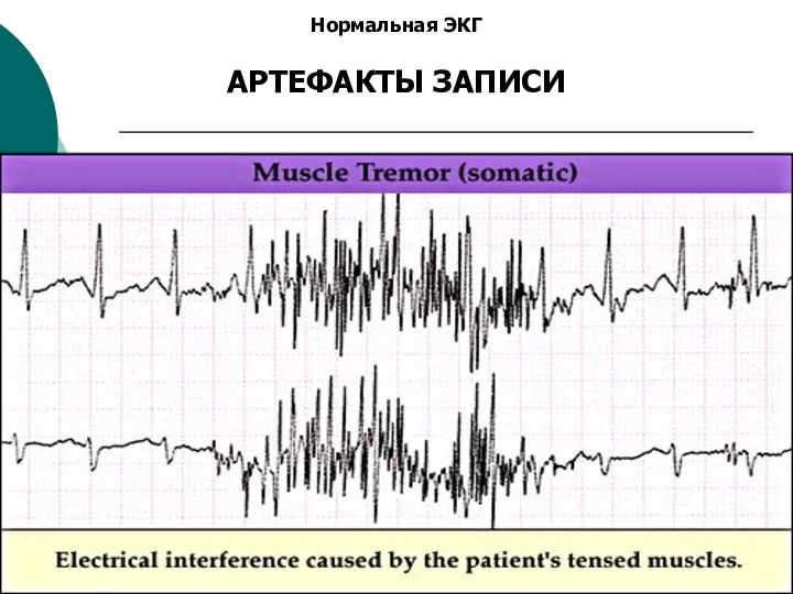 Нормальная ЭКГ АРТЕФАКТЫ ЗАПИСИ