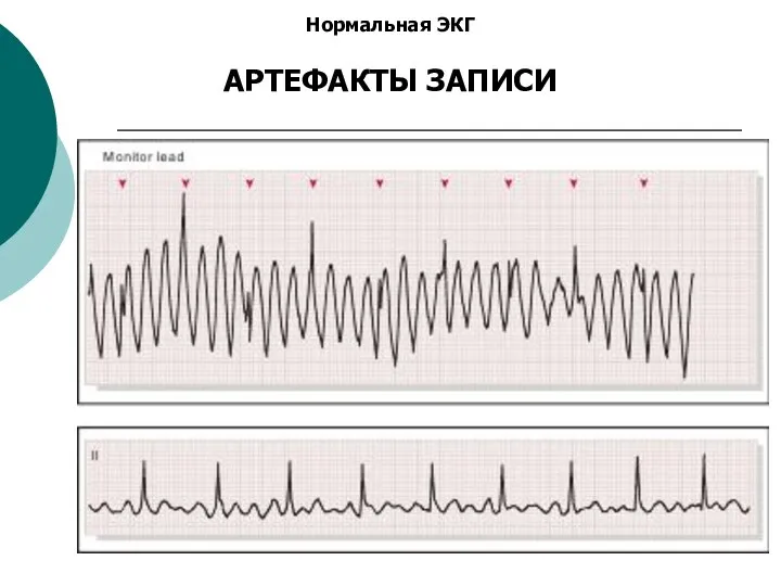 Нормальная ЭКГ АРТЕФАКТЫ ЗАПИСИ