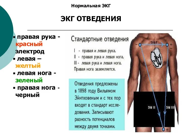 Нормальная ЭКГ ЭКГ ОТВЕДЕНИЯ правая рука - красный электрод левая – желтый