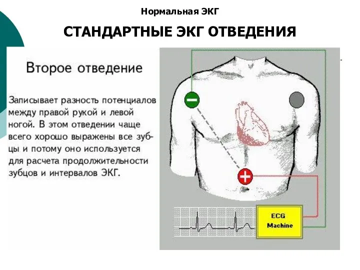 Нормальная ЭКГ СТАНДАРТНЫЕ ЭКГ ОТВЕДЕНИЯ