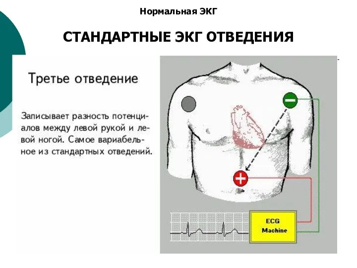 Нормальная ЭКГ СТАНДАРТНЫЕ ЭКГ ОТВЕДЕНИЯ