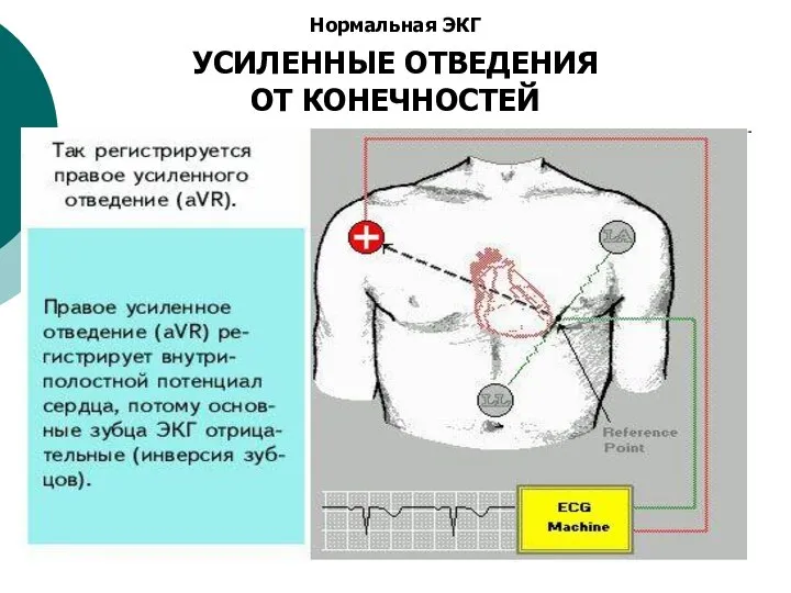 Нормальная ЭКГ УСИЛЕННЫЕ ОТВЕДЕНИЯ ОТ КОНЕЧНОСТЕЙ