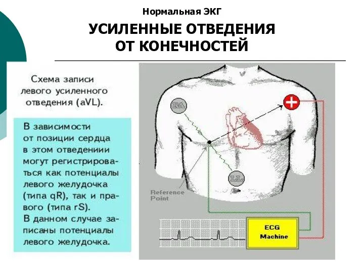 Нормальная ЭКГ УСИЛЕННЫЕ ОТВЕДЕНИЯ ОТ КОНЕЧНОСТЕЙ