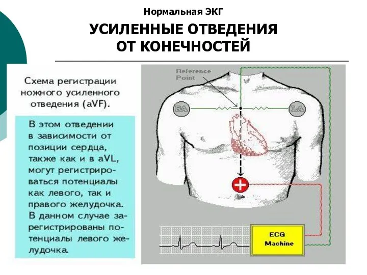 Нормальная ЭКГ УСИЛЕННЫЕ ОТВЕДЕНИЯ ОТ КОНЕЧНОСТЕЙ