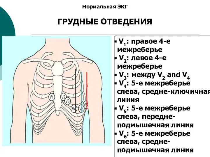 Нормальная ЭКГ ГРУДНЫЕ ОТВЕДЕНИЯ V1: правое 4-е межреберье V2: левое 4-е межреберье