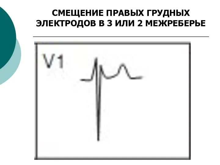 СМЕЩЕНИЕ ПРАВЫХ ГРУДНЫХ ЭЛЕКТРОДОВ В 3 ИЛИ 2 МЕЖРЕБЕРЬЕ