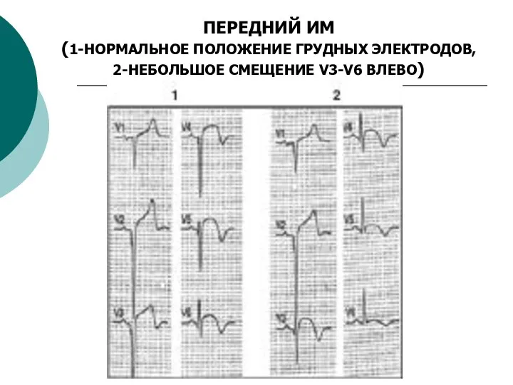 ПЕРЕДНИЙ ИМ (1-НОРМАЛЬНОЕ ПОЛОЖЕНИЕ ГРУДНЫХ ЭЛЕКТРОДОВ, 2-НЕБОЛЬШОЕ СМЕЩЕНИЕ V3-V6 ВЛЕВО)