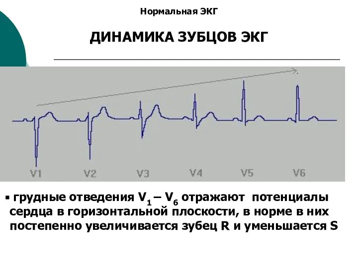 Нормальная ЭКГ ДИНАМИКА ЗУБЦОВ ЭКГ грудные отведения V1 – V6 отражают потенциалы