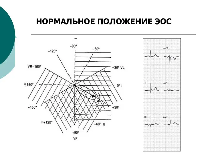 НОРМАЛЬНОЕ ПОЛОЖЕНИЕ ЭОС