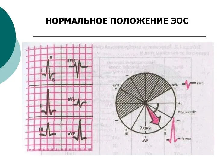 НОРМАЛЬНОЕ ПОЛОЖЕНИЕ ЭОС