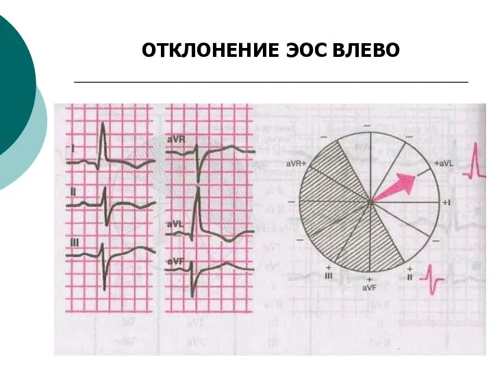 ОТКЛОНЕНИЕ ЭОС ВЛЕВО