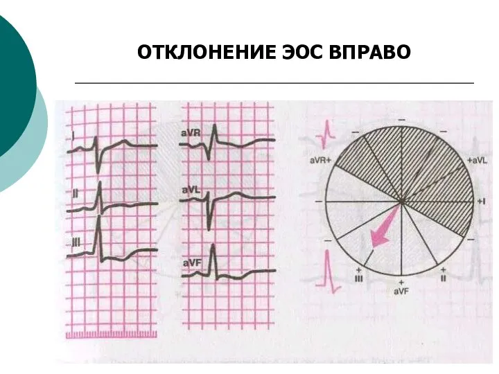 ОТКЛОНЕНИЕ ЭОС ВПРАВО