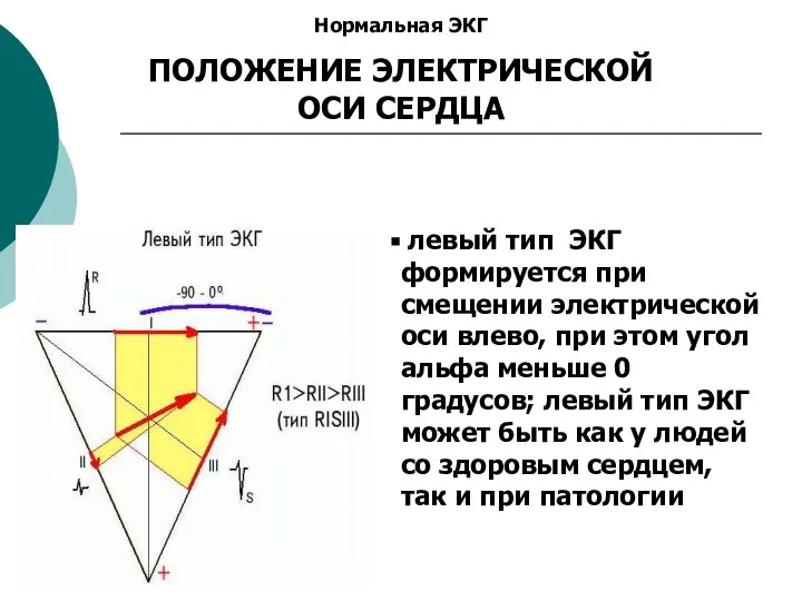 Нормальная ЭКГ ПОЛОЖЕНИЕ ЭЛЕКТРИЧЕСКОЙ ОСИ СЕРДЦА левый тип ЭКГ формируется при смещении