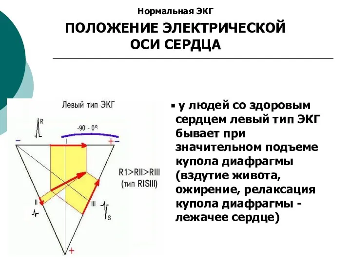 Нормальная ЭКГ ПОЛОЖЕНИЕ ЭЛЕКТРИЧЕСКОЙ ОСИ СЕРДЦА у людей со здоровым сердцем левый