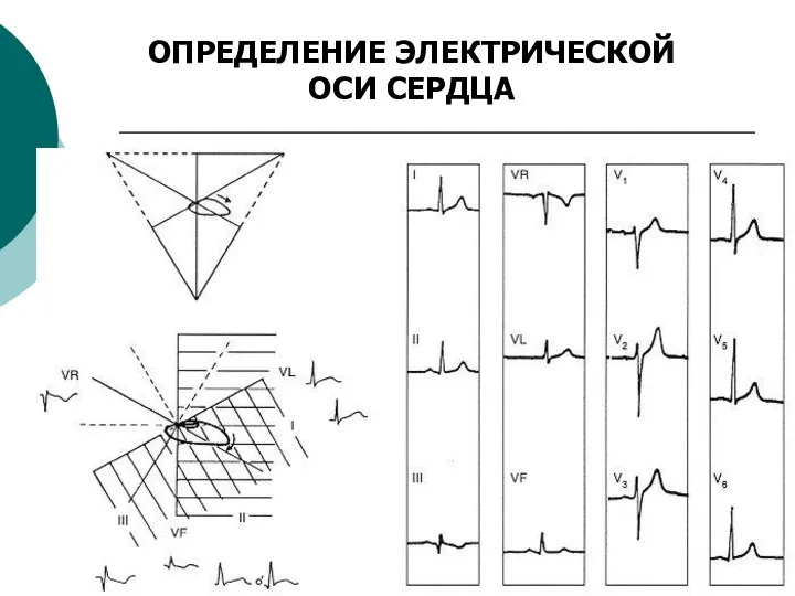 ОПРЕДЕЛЕНИЕ ЭЛЕКТРИЧЕСКОЙ ОСИ СЕРДЦА