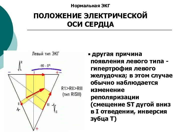 Нормальная ЭКГ ПОЛОЖЕНИЕ ЭЛЕКТРИЧЕСКОЙ ОСИ СЕРДЦА другая причина появления левого типа -