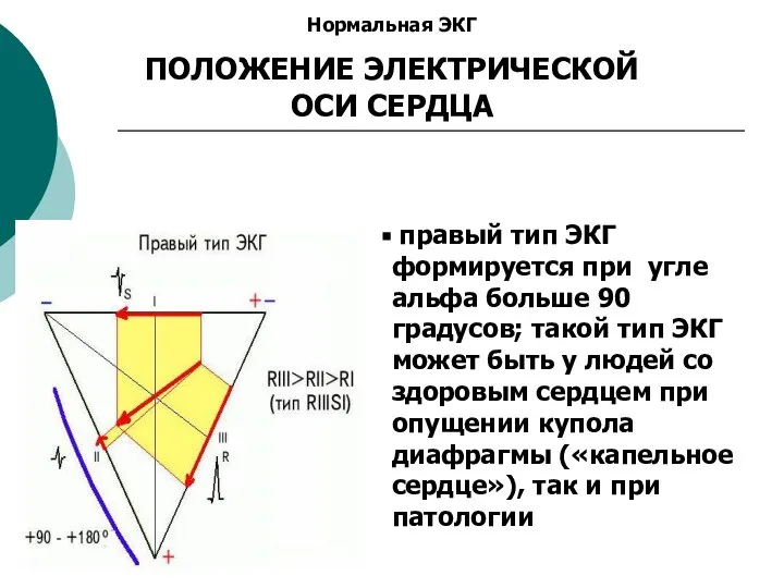 Нормальная ЭКГ ПОЛОЖЕНИЕ ЭЛЕКТРИЧЕСКОЙ ОСИ СЕРДЦА правый тип ЭКГ формируется при угле