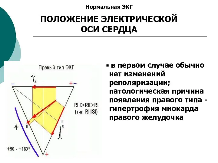 Нормальная ЭКГ ПОЛОЖЕНИЕ ЭЛЕКТРИЧЕСКОЙ ОСИ СЕРДЦА в первом случае обычно нет изменений