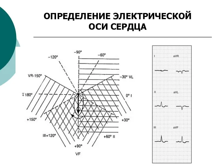 ОПРЕДЕЛЕНИЕ ЭЛЕКТРИЧЕСКОЙ ОСИ СЕРДЦА