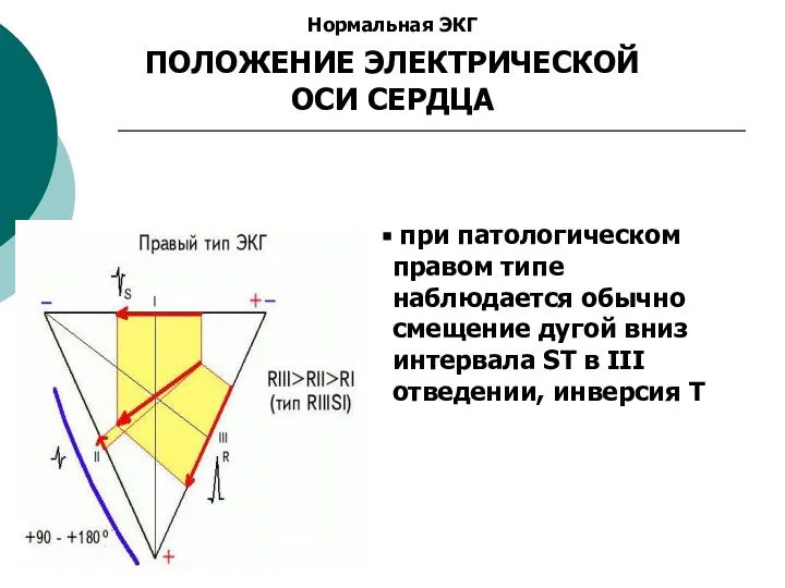 Нормальная ЭКГ ПОЛОЖЕНИЕ ЭЛЕКТРИЧЕСКОЙ ОСИ СЕРДЦА при патологическом правом типе наблюдается обычно