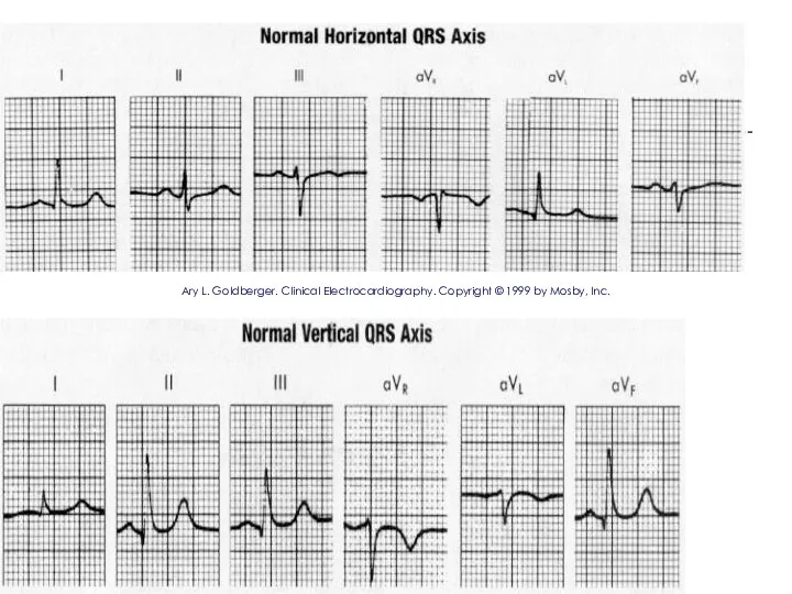 Ary L. Goldberger. Clinical Electrocardiography. Copyright © 1999 by Mosby, Inc.