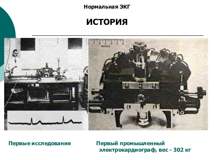 Нормальная ЭКГ ИСТОРИЯ Первые исследования Первый промышленный электрокардиограф, вес - 302 кг