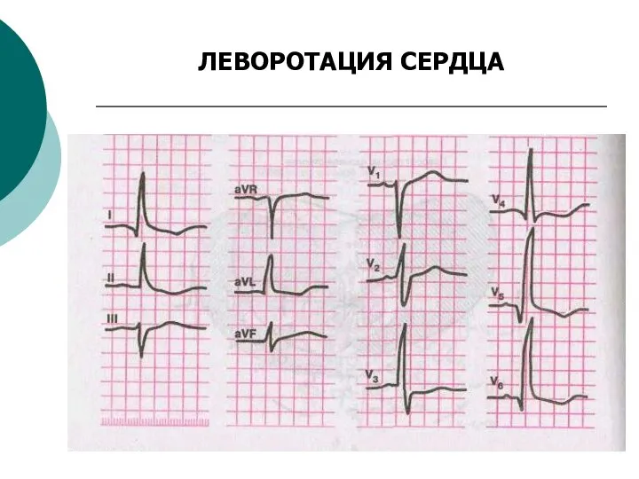 ЛЕВОРОТАЦИЯ СЕРДЦА