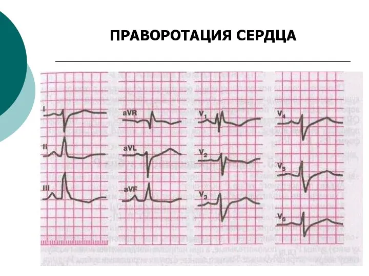 ПРАВОРОТАЦИЯ СЕРДЦА