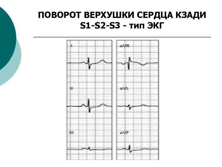 ПОВОРОТ ВЕРХУШКИ СЕРДЦА КЗАДИ S1-S2-S3 - тип ЭКГ