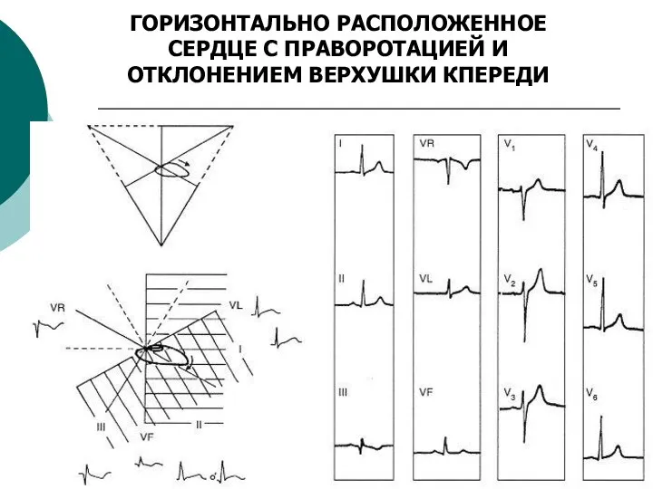 ГОРИЗОНТАЛЬНО РАСПОЛОЖЕННОЕ СЕРДЦЕ С ПРАВОРОТАЦИЕЙ И ОТКЛОНЕНИЕМ ВЕРХУШКИ КПЕРЕДИ