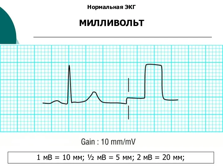 Нормальная ЭКГ МИЛЛИВОЛЬТ 1 мВ = 10 мм; ½ мВ = 5