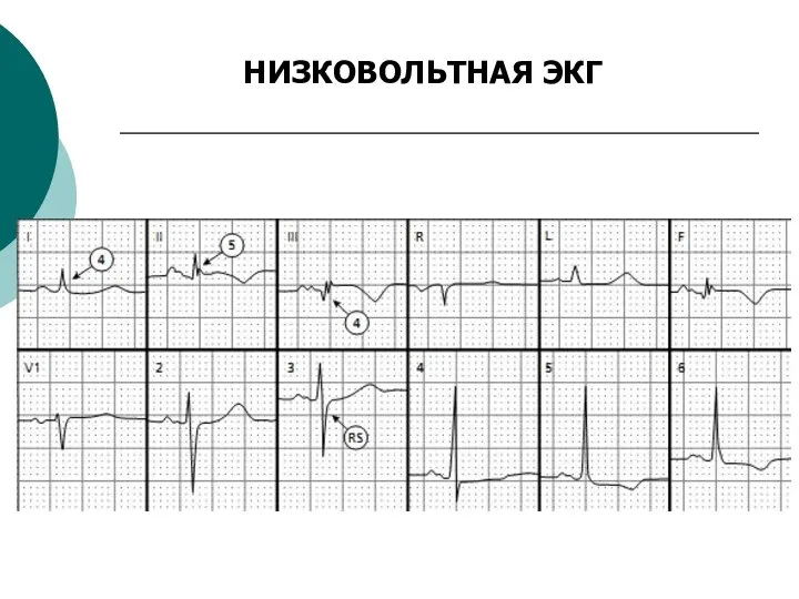 НИЗКОВОЛЬТНАЯ ЭКГ