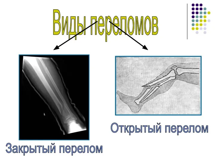 Виды переломов Закрытый перелом Открытый перелом