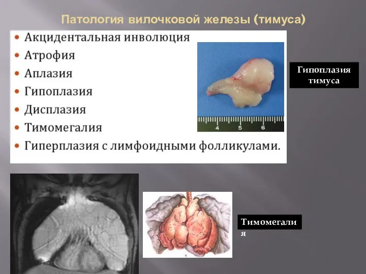 Патология вилочковой железы (тимуса) Гипоплазия тимуса Тимомегалия