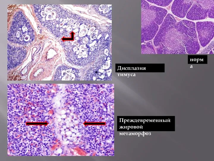 Дисплазия тимуса Преждевременный жировой метаморфоз норма