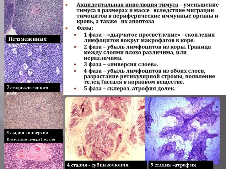 Неизмененный тимус 2 стадия»звездного неба» 3 стадия «инверсия слоев» 3 стадия 3