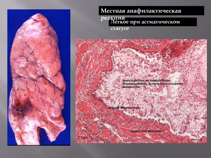 Легкое при астматическом статусе Местная анафилактическая реакция