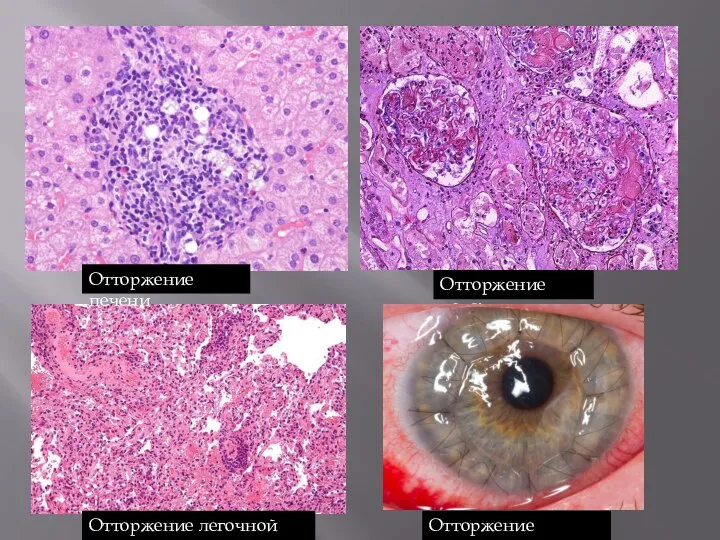 Отторжение легочной ткани Отторжение печени Отторжение почки Отторжение роговицы