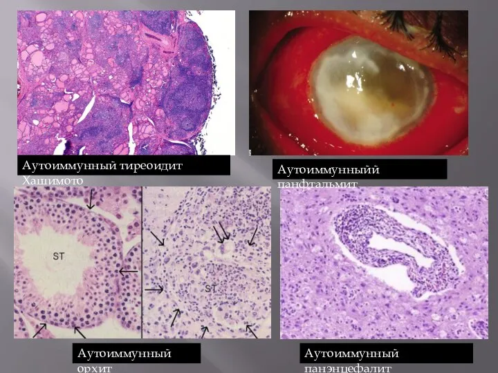 Аутоиммунный тиреоидит Хашимото Аутоиммунныйй панфтальмит Аутоиммунный орхит Аутоиммунный панэнцефалит